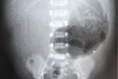 yelco-arterial-femoral-izq-cateter-venoso-femoral-der-gastroparesia-1996-001